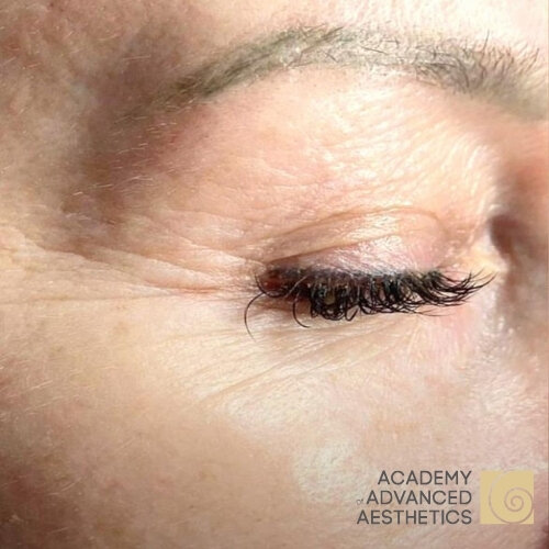 Retix.C EYE+_before_1