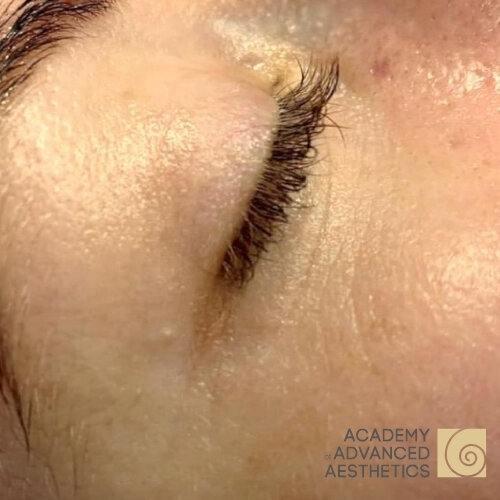 Retix.C EYE+_after_1