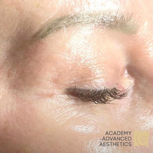 Retix.C EYE+_after_1