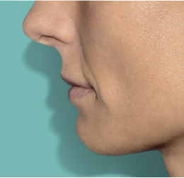 Belotero Revive_before_1