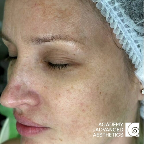 Retix.C Peptiglow Retiskin.LAB_before_1