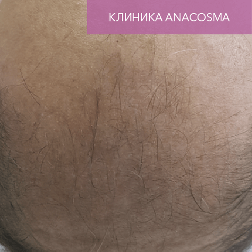 Endoret PRGF_before_1