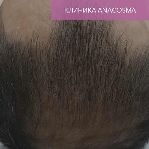 Endoret PRGF_after_1