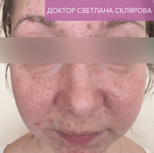 Endoret PRGF_before_2