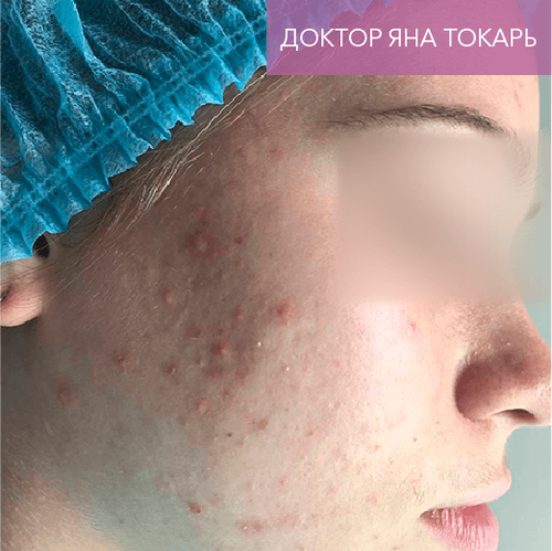 Endoret PRGF_before_3