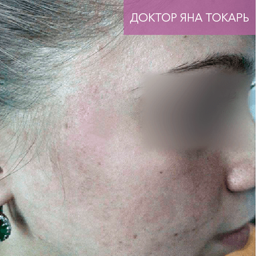 Endoret PRGF_after_3