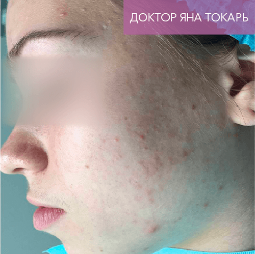 Endoret PRGF_before_4