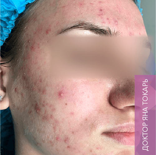 Endoret PRGF_before_5