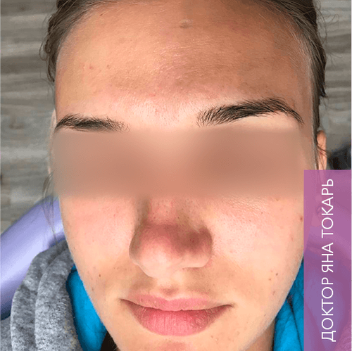 Endoret PRGF_after_5