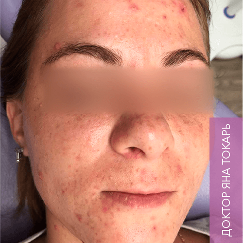 Endoret PRGF_before_6