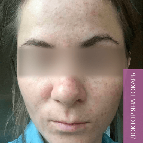 Endoret PRGF_after_6