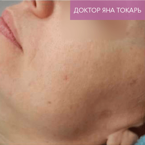 Endoret PRGF_after_7