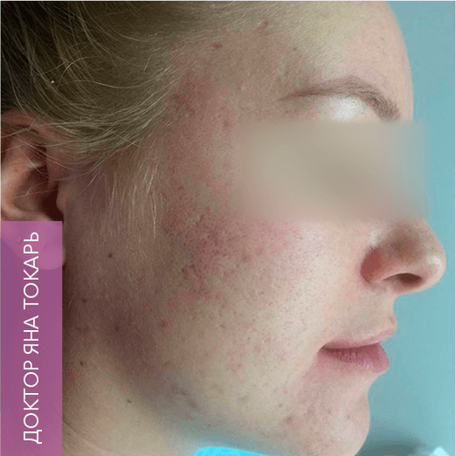 Endoret PRGF_before_8