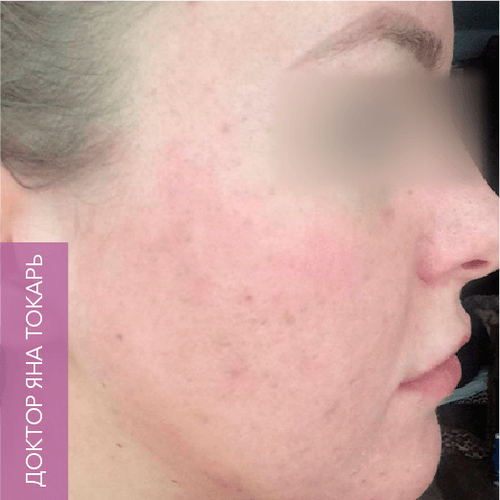 Endoret PRGF_after_8