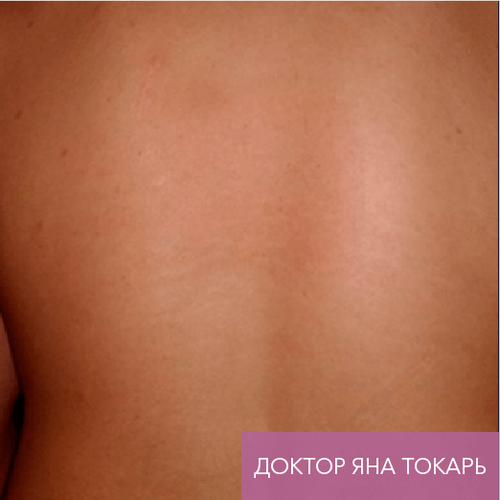 Endoret PRGF_after_9