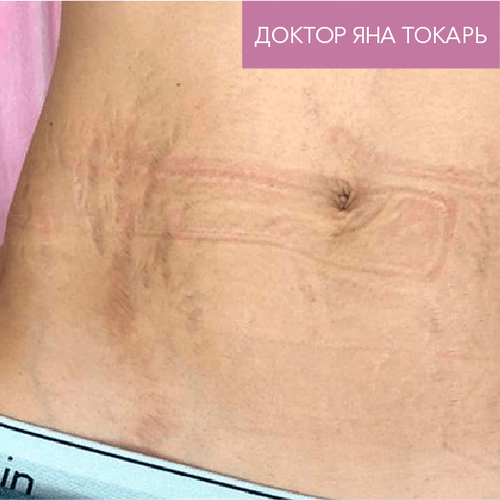 Endoret PRGF_before_10