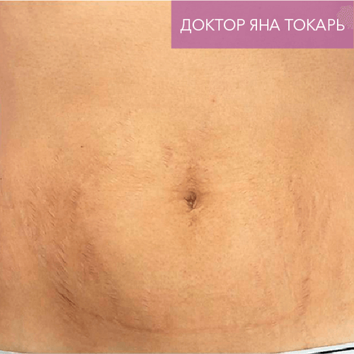 Endoret PRGF_after_10