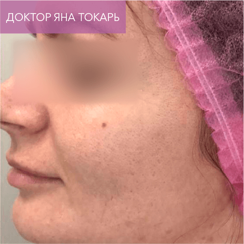 Endoret PRGF_after_11