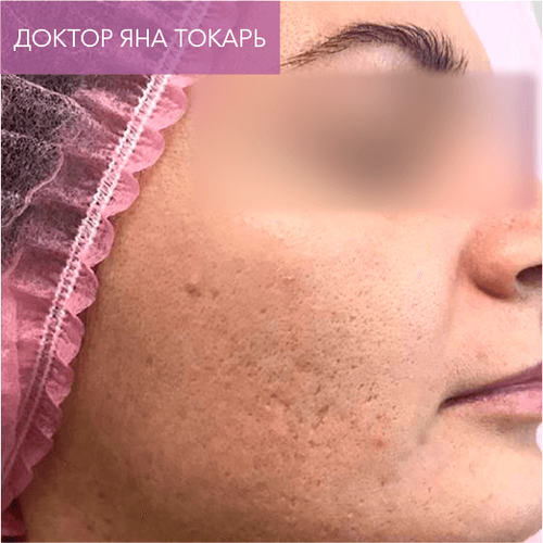 Endoret PRGF_before_12