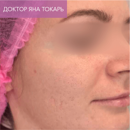 Endoret PRGF_after_12