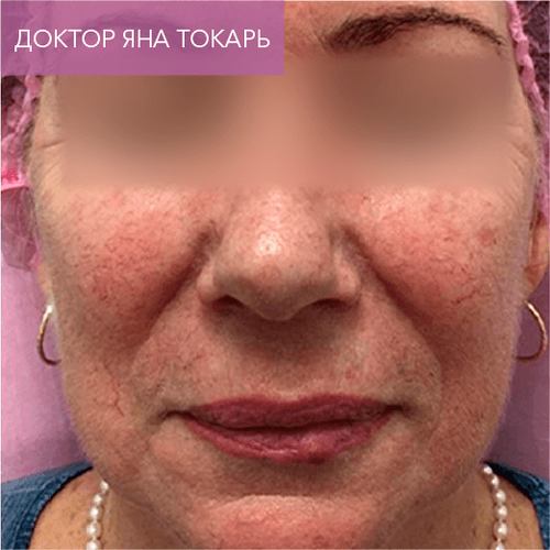 Endoret PRGF_before_13