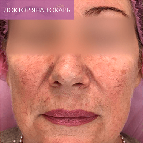 Endoret PRGF_after_13