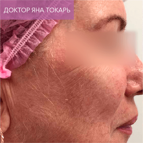 Endoret PRGF_before_14