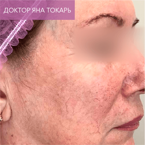 Endoret PRGF_after_14