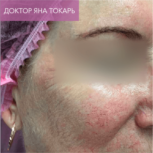 Endoret PRGF_before_15