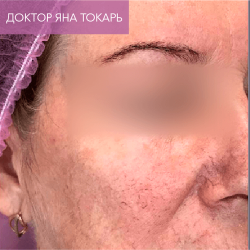 Endoret PRGF_after_15