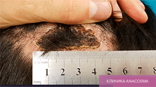 Endoret PRGF_after_16