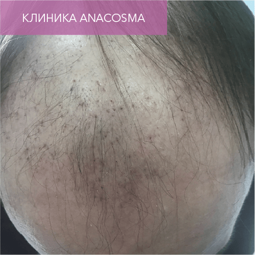 Endoret PRGF_before_17