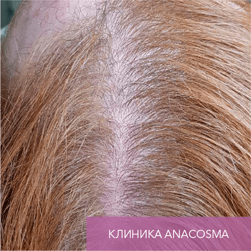 Endoret PRGF_before_18