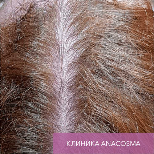 Endoret PRGF_after_18