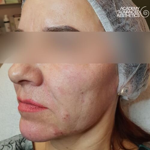 Radiesse_after_1