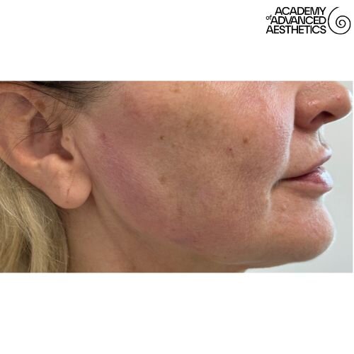 Radiesse_after_6