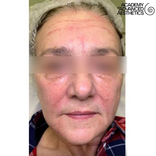 Radiesse_after_7