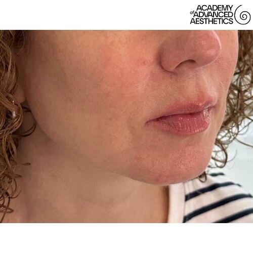 Radiesse_after_2