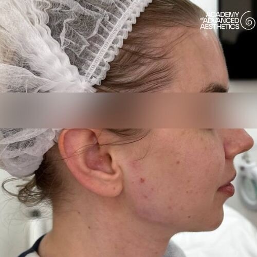 Radiesse_after_2