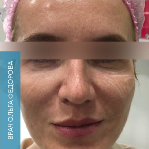 Radiesse_before_8