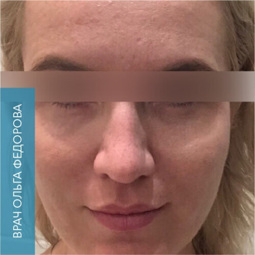Radiesse_after_8