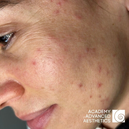 Retix.C Retibooster_before_1