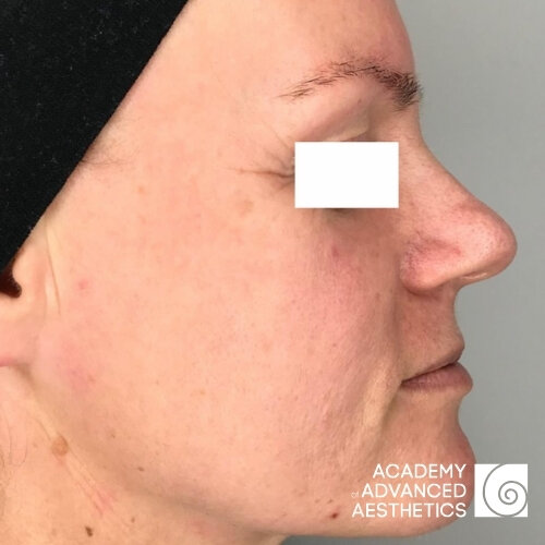 Retix.C Retibooster_before_2