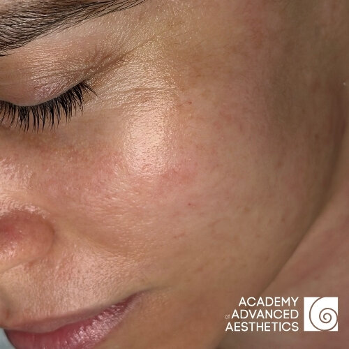 Retix.C Retibooster_after_1