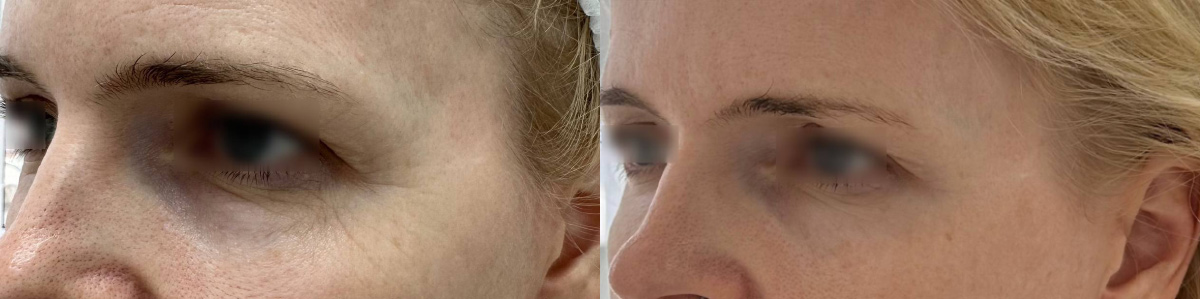 Полімолочна кислота Juvelook & Lenisna